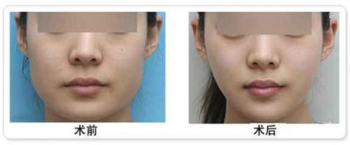 吸脂瘦脸手术的恢复时间需要几天？