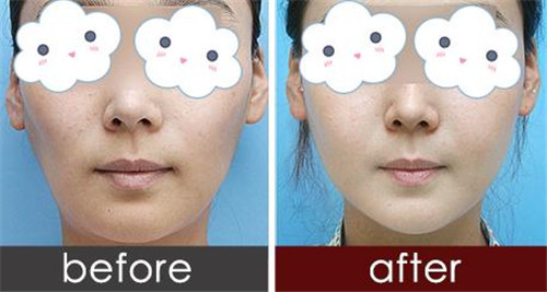 吸脂瘦脸的恢复时间通常需要几天
