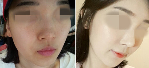 韩式小翘鼻术会留疤吗，有哪些副作用