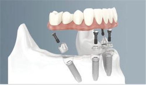 阜新牙齿牙髓治疗技术效果怎么样