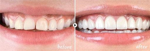 莱芜国产钛基牙(BAM)种植牙整形手术价格需要多少