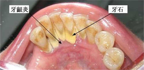 东营艾雅口腔诊所价目表详细解密附微创种植牙齿案例